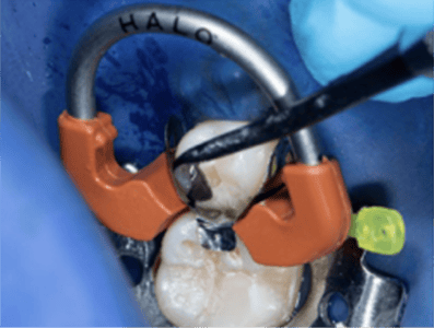 Blog_Halo_Clinical_Guide_DrRichins_6