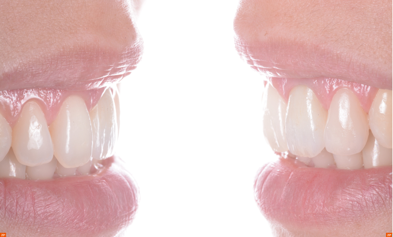 Restauration inscisive sur dents assombrie / cac clinique _esthétique dentaire.